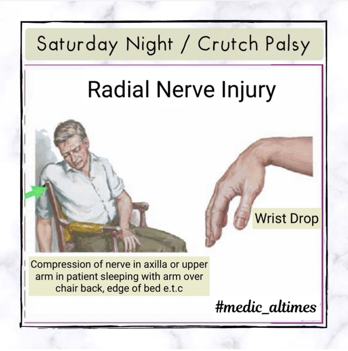 Read more about the article Saturday Night Palsy