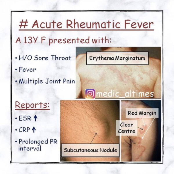 acute-rheumatic-fever-medical-times