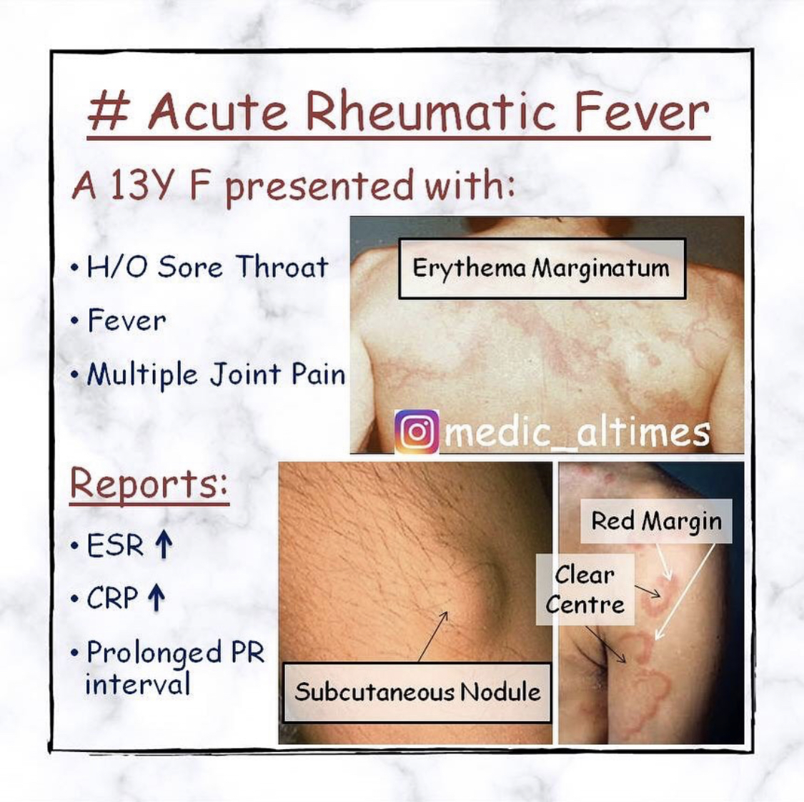 subcutaneous nodules rheumatic fever